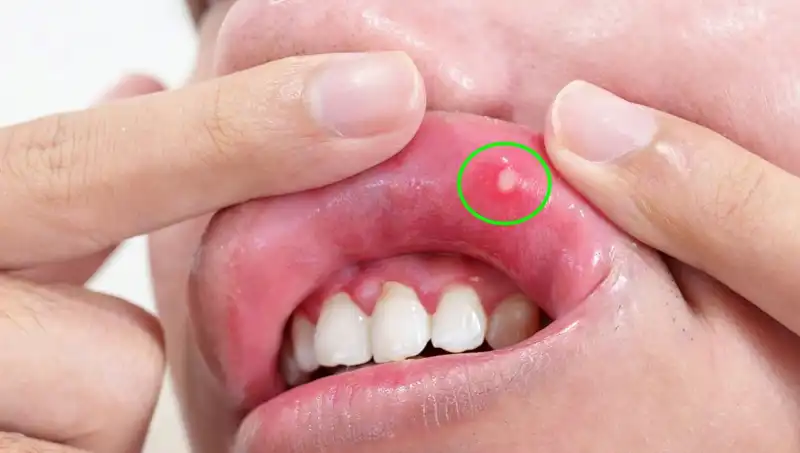 Vücudunuzdaki 5 Belirgin B Vitamini Eksikliği Belirtileri