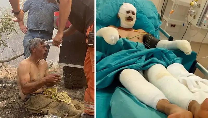 Yangında yaralanan orman işçisinin sağlık durumu merak konusu oldu