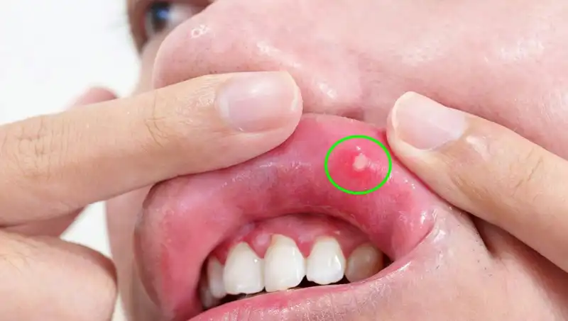 Anormal Belirtileri Görmezden Gelen Genç Kadın Kanserle Sınandı